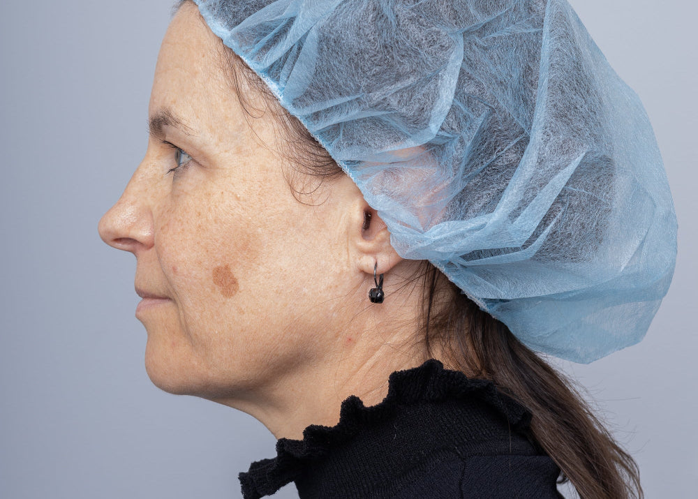 Laser Pigmentation Treatment Using PICO Enlighten III