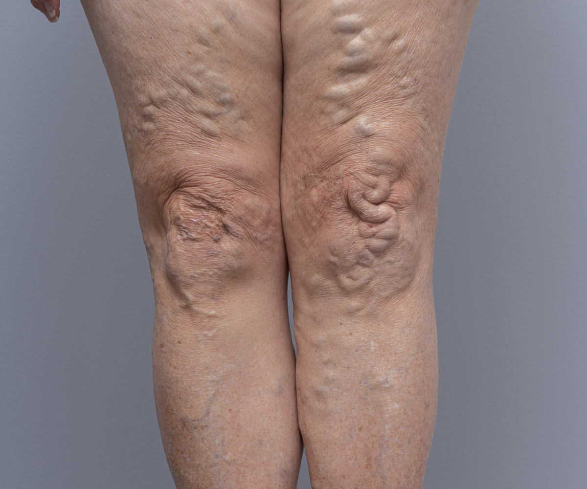 Varicose Vein Treatment with EVLA, UGS & Sclerotherapy