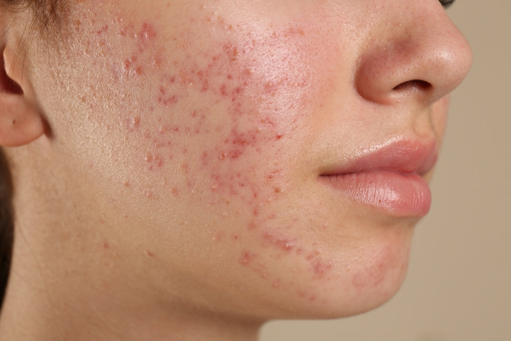 Acne: Causes, Assessment, Treatment, and When to Seek Medical Advice