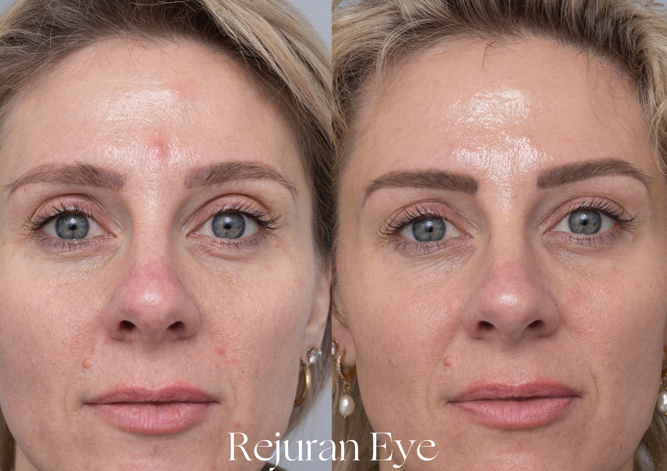 Skin Rejuvenation with Rejuran