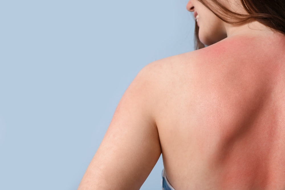 Sun-Damaged Skin